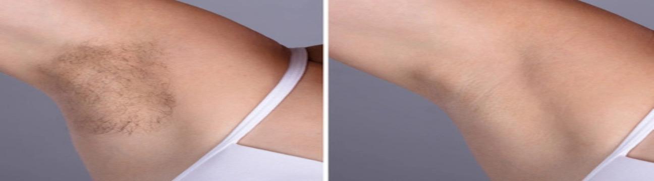 Laser Removal